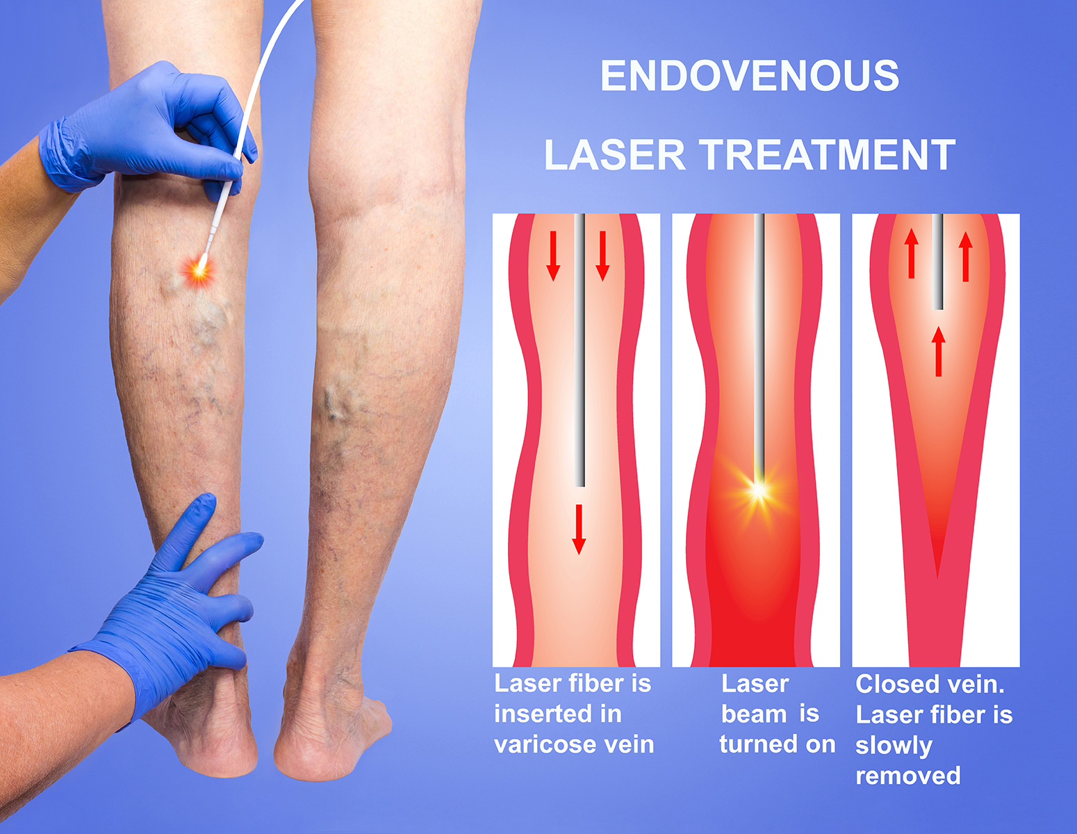 What Makes a Hospital the Best Choice for Varicose Veins Treatment in India?